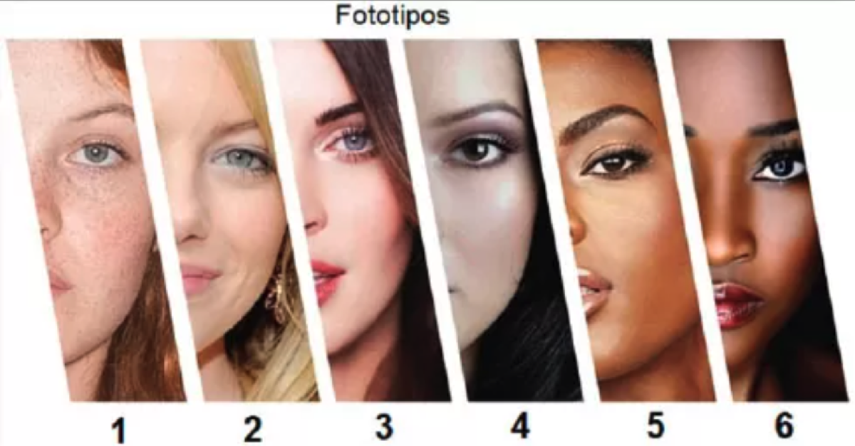 classificação de fototipos Fitzpatrick