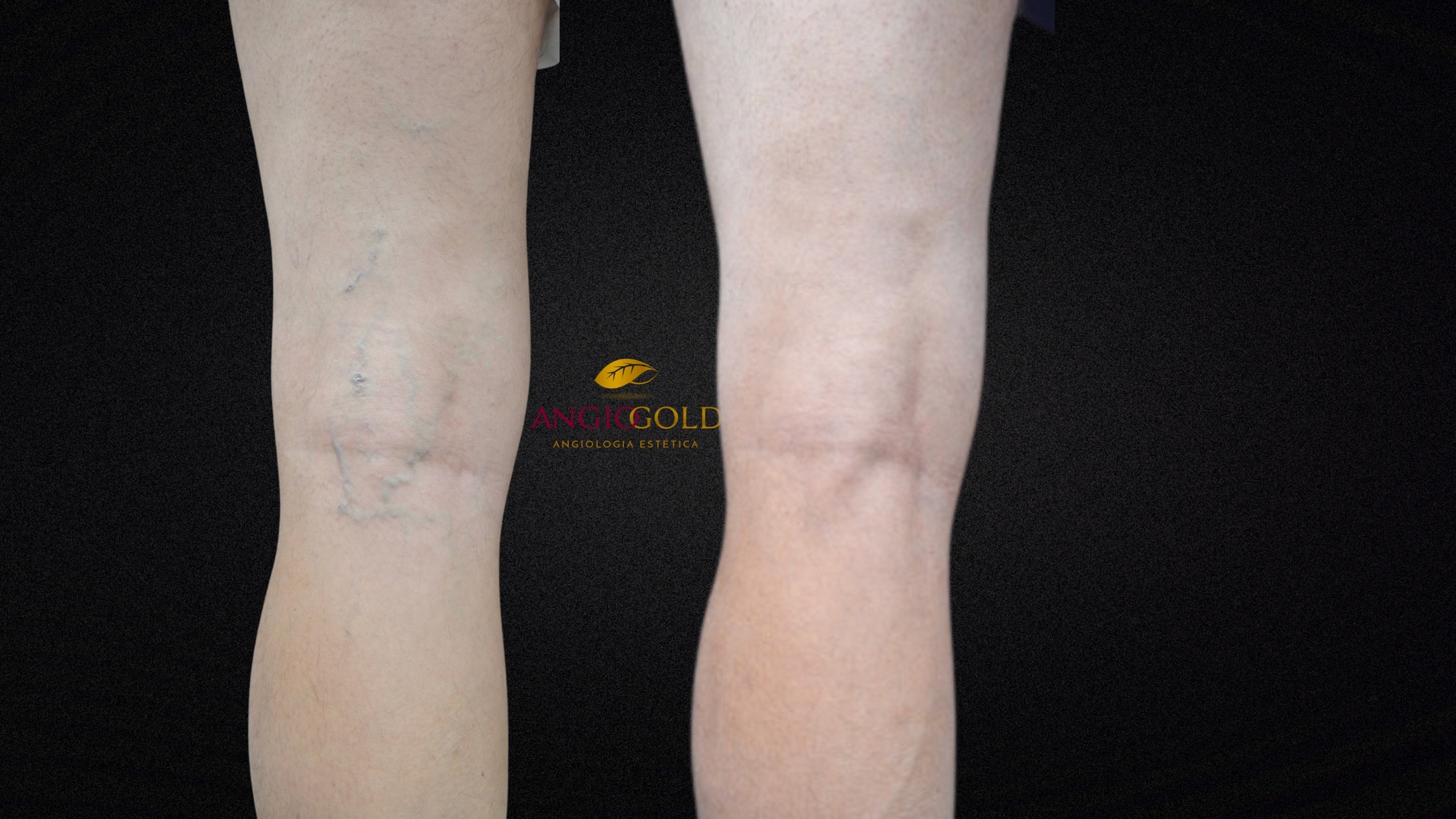 Antes e depois varizes laser AngioGold