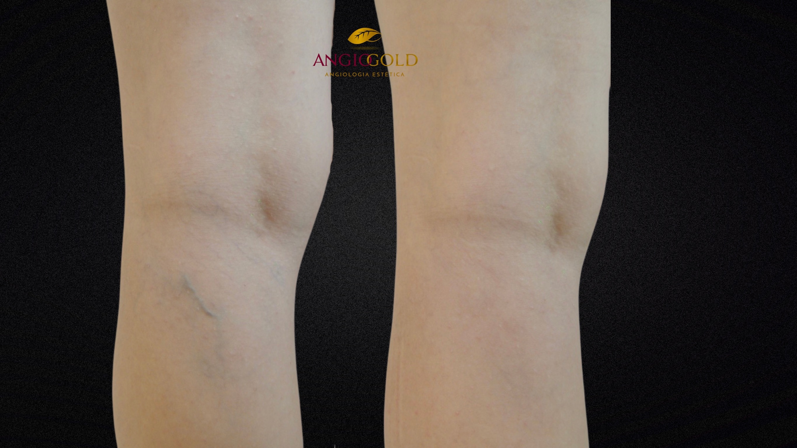 Escleroterapia antes e depois AngioGold