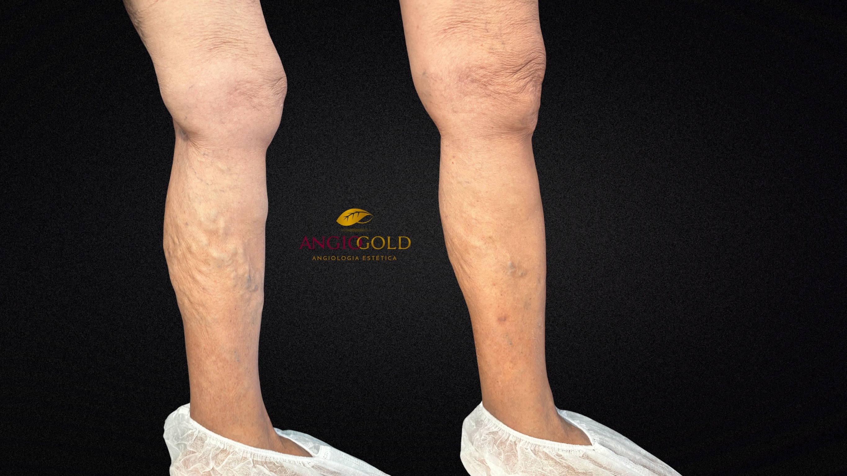 Laser varizes resultado antes depois BH