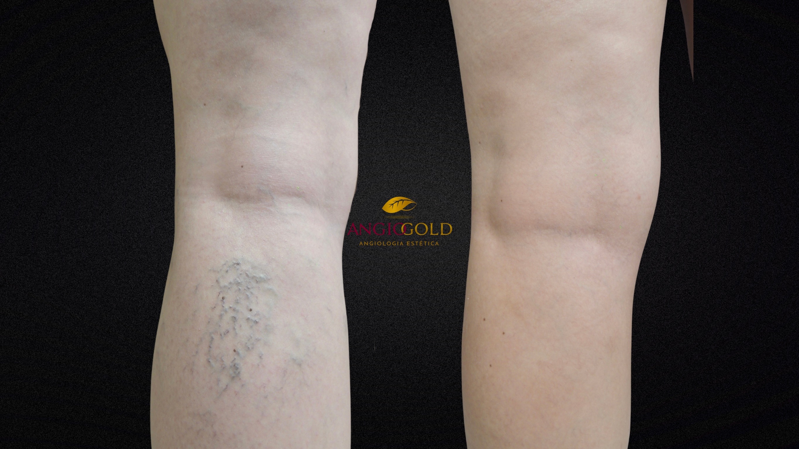 Remoção varizes laser Belo Horizonte
