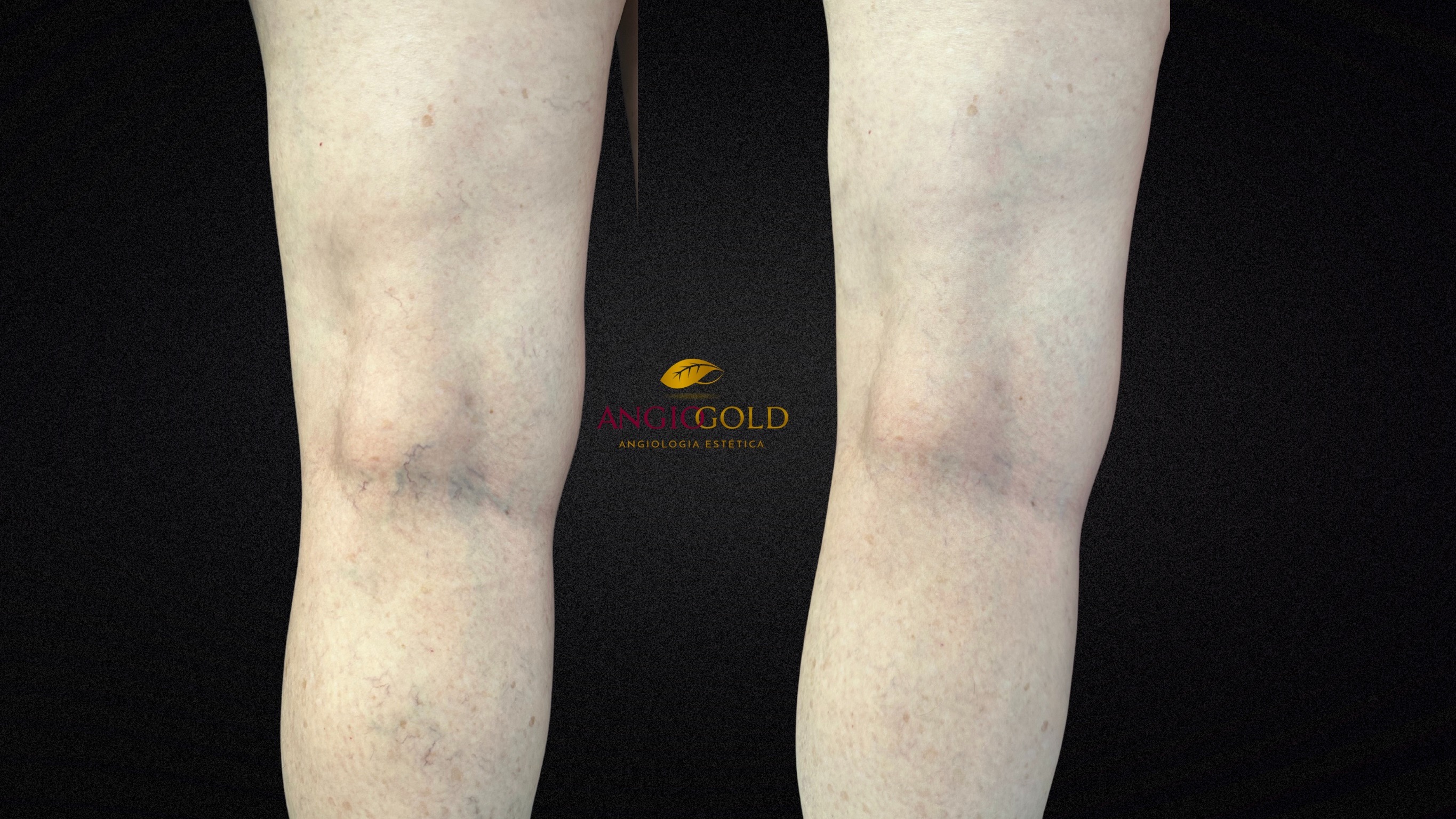 Resultado vasinhos laser AngioGold