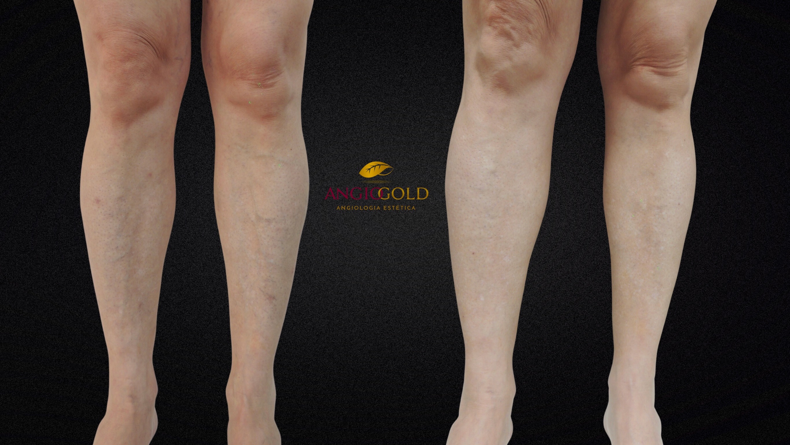 Antes e depois tratamento vascular BH