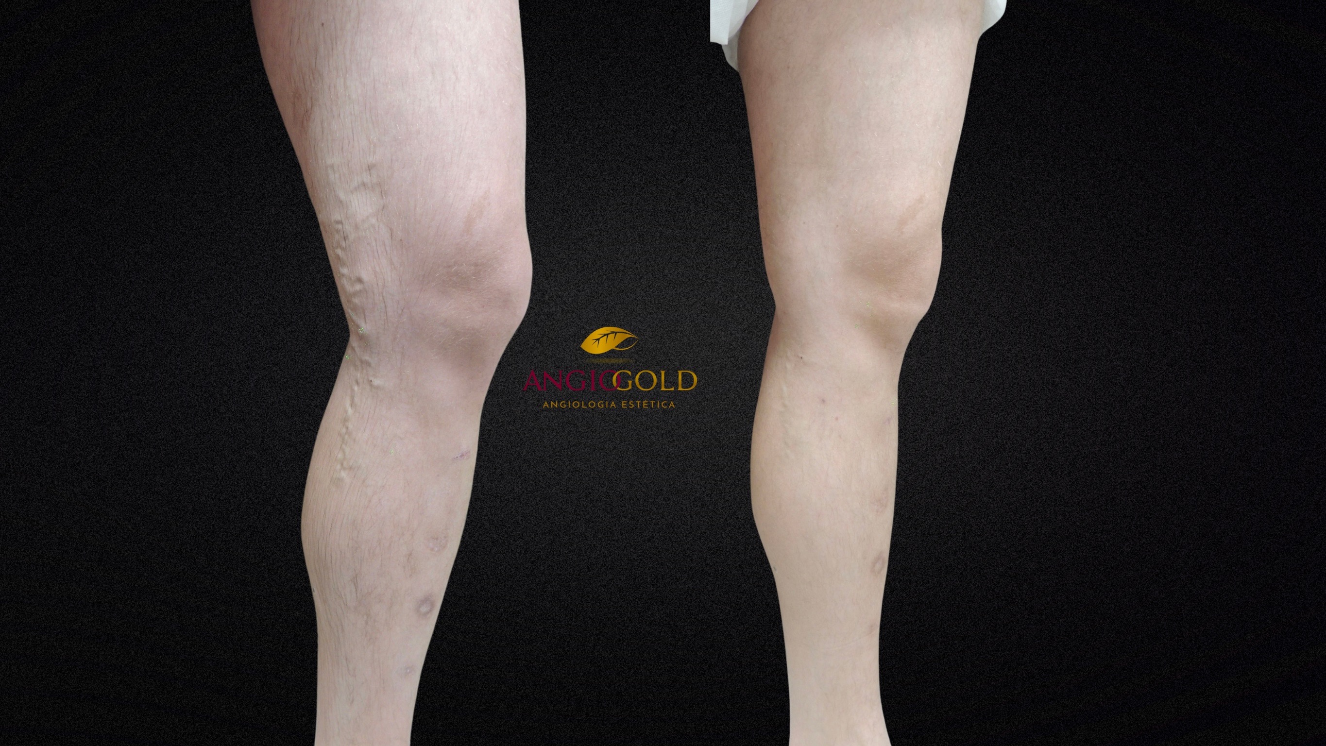 Laser varizes antes depois Belvedere BH