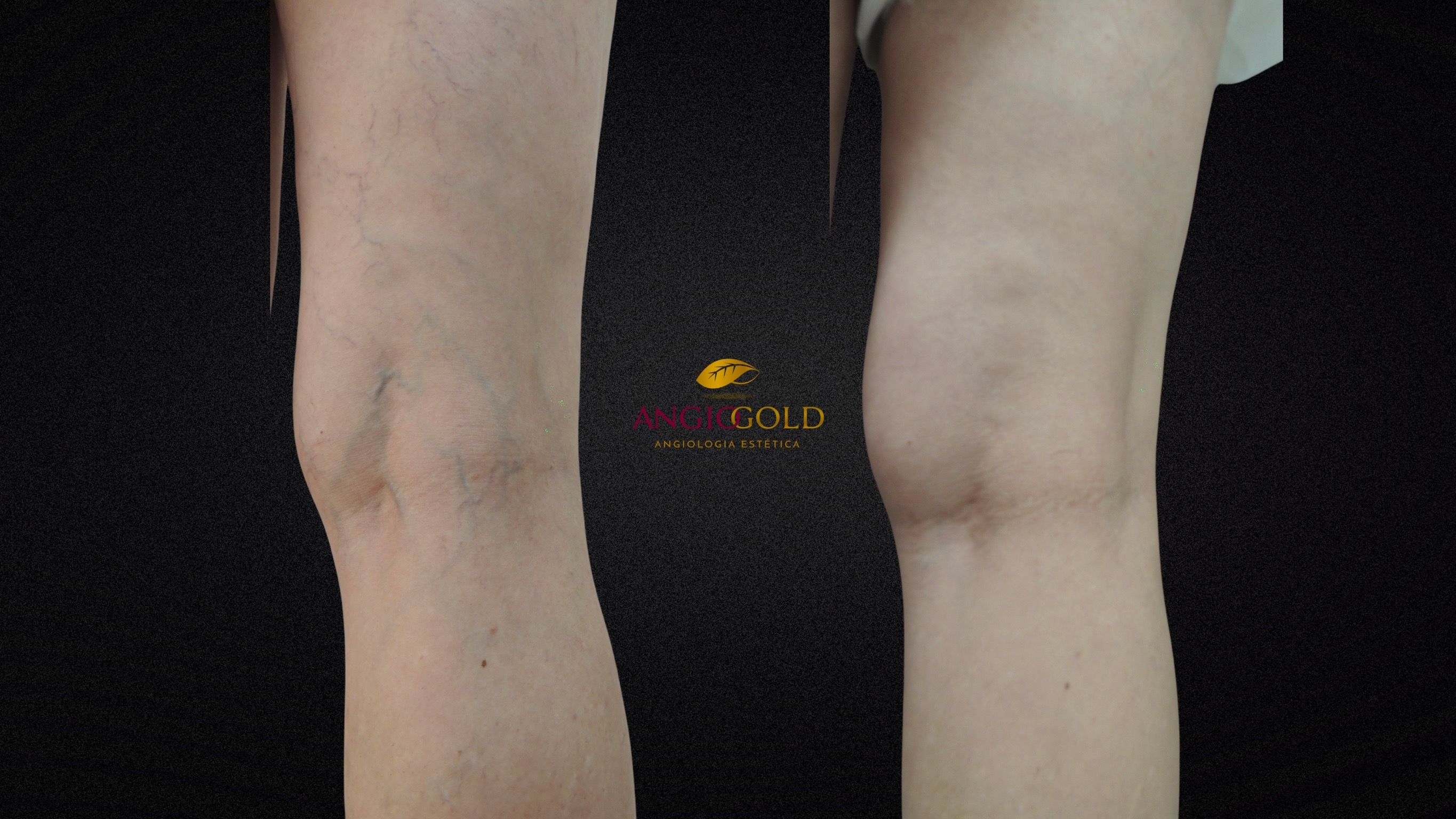 Resultado escleroterapia AngioGold BH