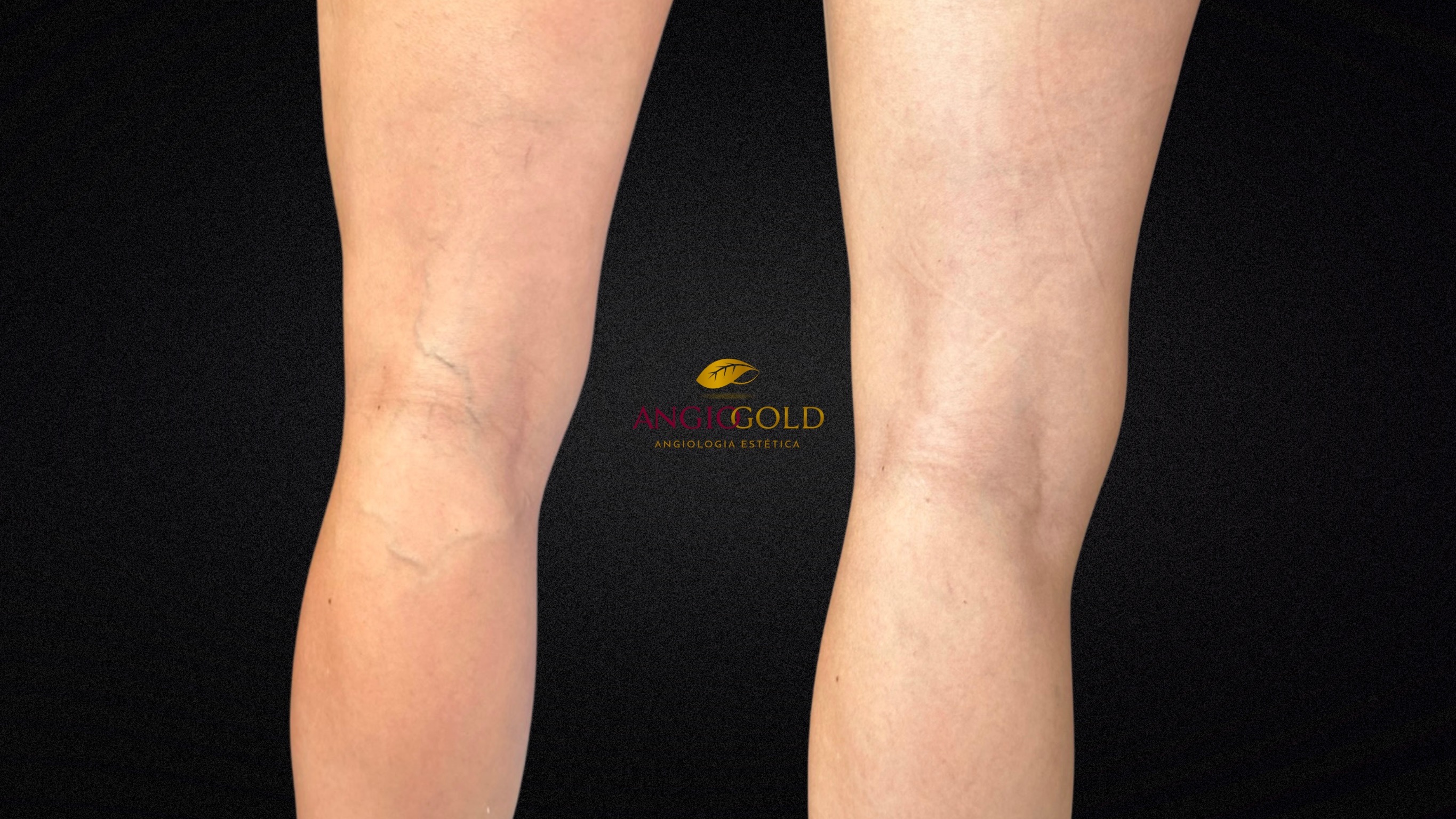 Varizes laser resultado clínica BH