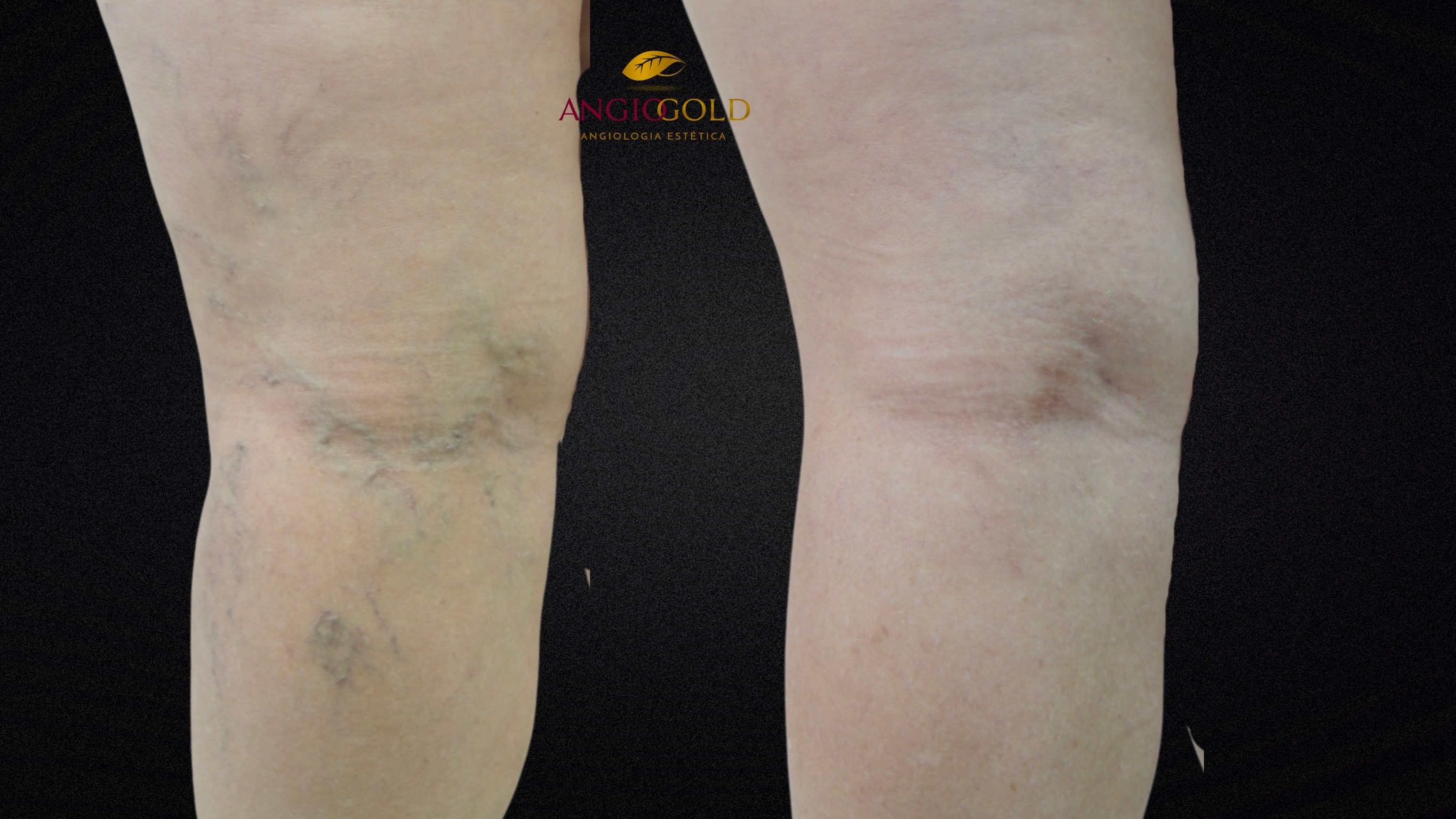 Antes depois remoção varizes laser BH