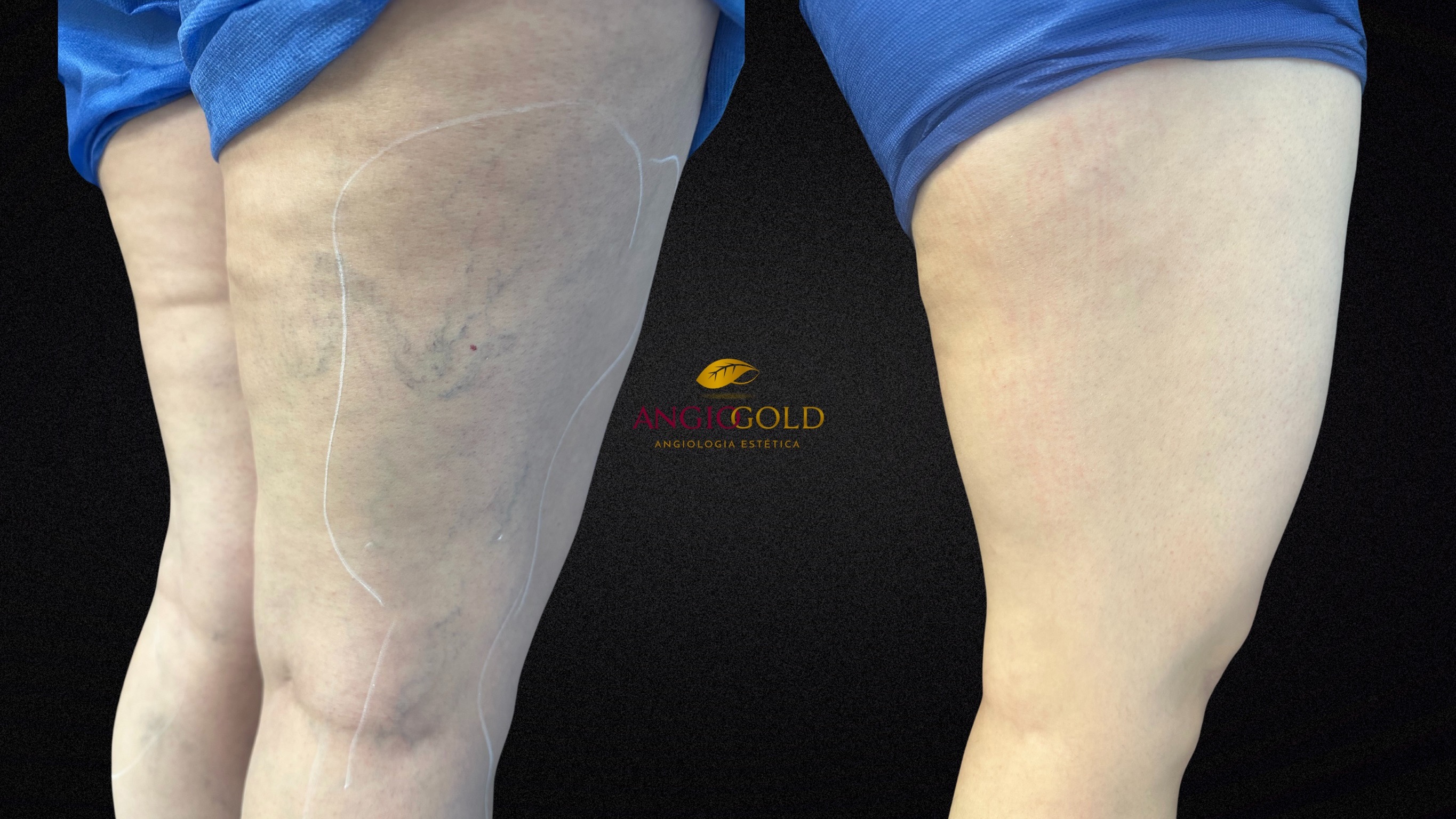 Tratamento varizes resultado AngioGold