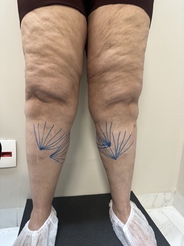 Avaliação clínica de paciente com lipedema na AngioGold — mapeamento individualizado da condição