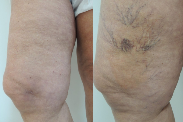 Varizes e saude vascular — VERDADES SOBRE VARIZES | Clinica AngioGold BH