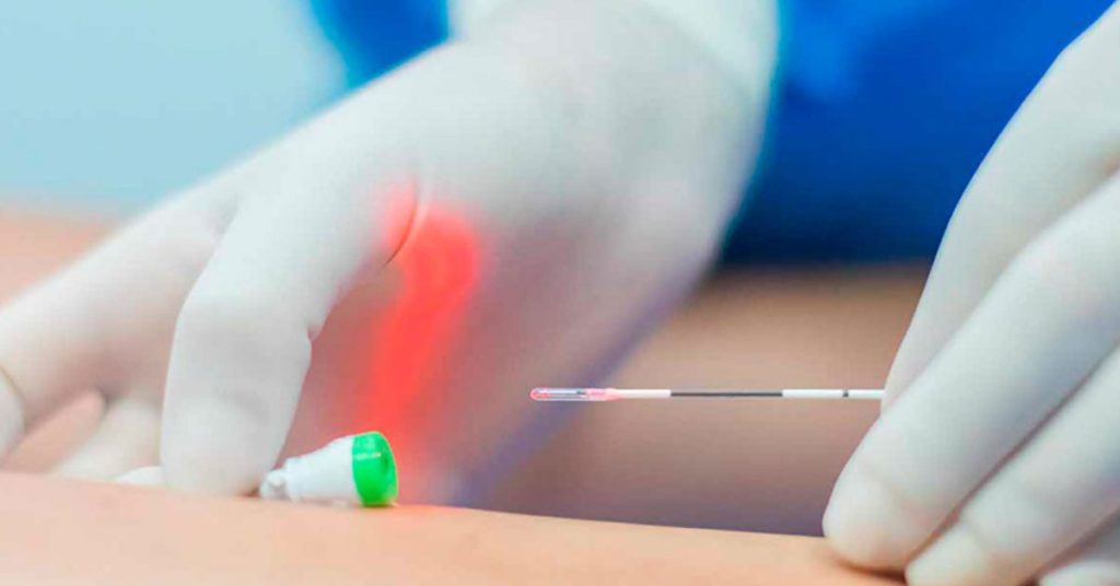 Tratamento da safena com laser sem cirurgia na Clinica AngioGold — Tratamento da Safena: LASER x ESPUMA x CIRURGIA