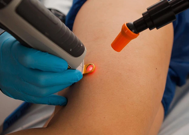 Tratamento de vasinhos e microvarizes com laser transdermico — Clinica AngioGold BH