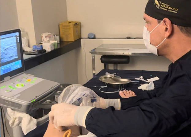 Tratamento de vasinhos e microvarizes com laser transdermico — Clinica AngioGold BH