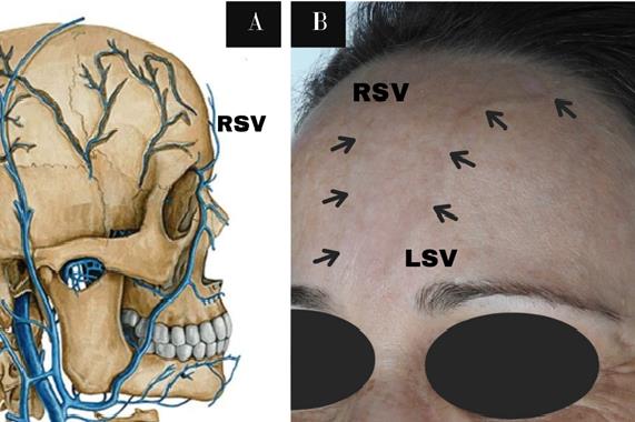 Anatomia das veias supratrocleares