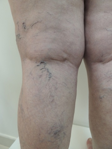 Antes tratamento varizes laser