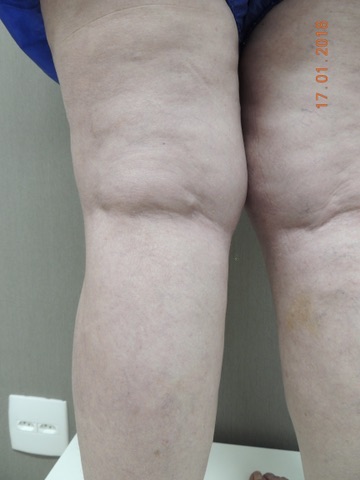 Depois tratamento varizes laser