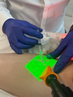 Escleroterapia guiada por Vein Viewer com Siberian ao lado para anestesia por resfriamento durante o tratamento de vasinhos