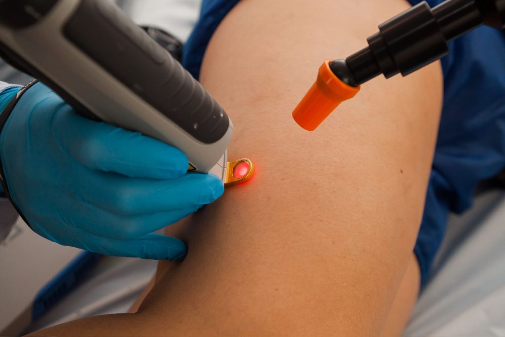 Laser para varizes sem dor: close-up do procedimento na Clinica AngioGold com aparelho Siberian de resfriamento (-25°C) disparando ar frio simultaneamente ao laser, evitando dor e protegendo a pele.