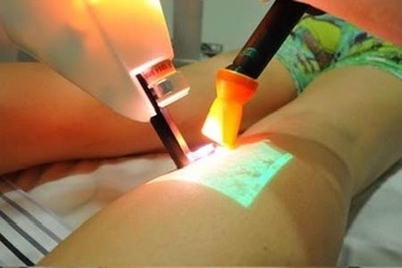 Aplicação do laser transdérmico para varizes com Siberian liberando ar frio sobre a perna da paciente