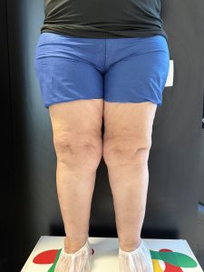Lipedema nao e obesidade: paciente com lipedema estagio 2 mostrando acumulo simetrico de gordura nas pernas, depressoes caracteristicas nos joelhos e desproporcao entre tronco e membros inferiores. Clinica AngioGold Belo Horizonte.