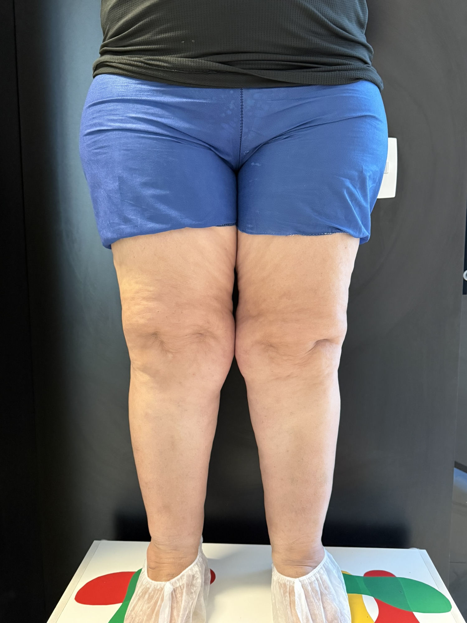 Lipedema não é obesidade: paciente com acúmulo simétrico de gordura nas pernas, depressões nos joelhos e desproporção entre tronco e membros inferiores