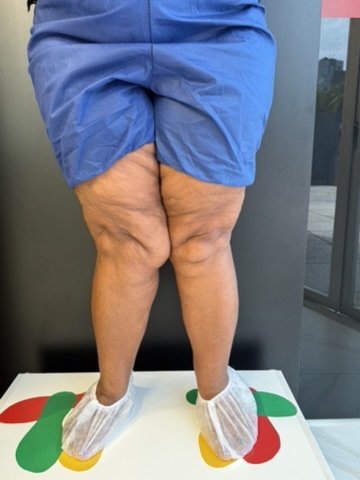 Lipedema nas pernas vista posterior mostrando acúmulo simétrico e textura nodular da pele