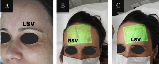 Vein Viewer