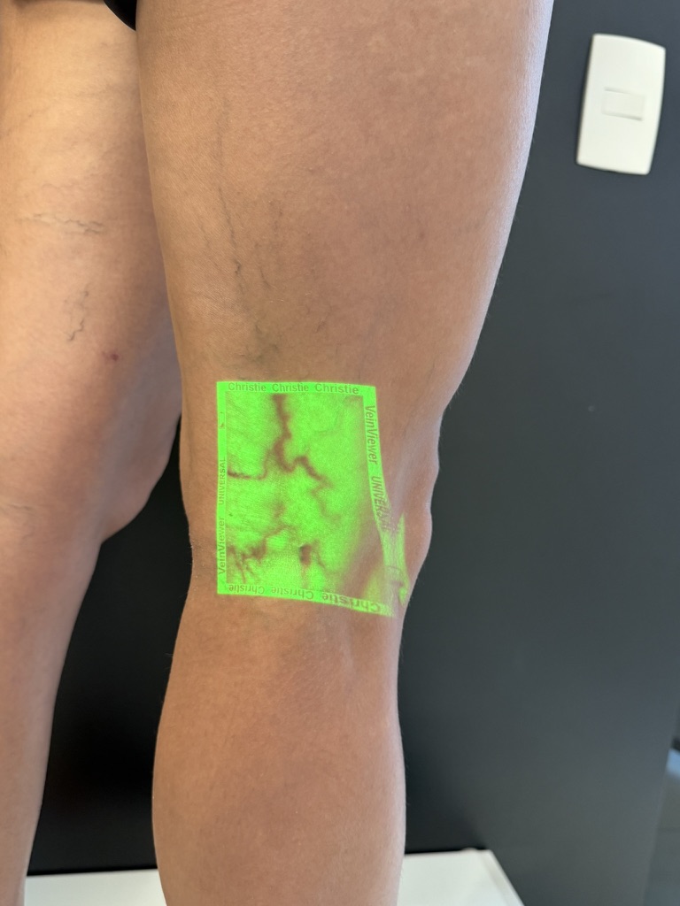 Vein Viewer projetando vasos sanguíneos — AngioGold