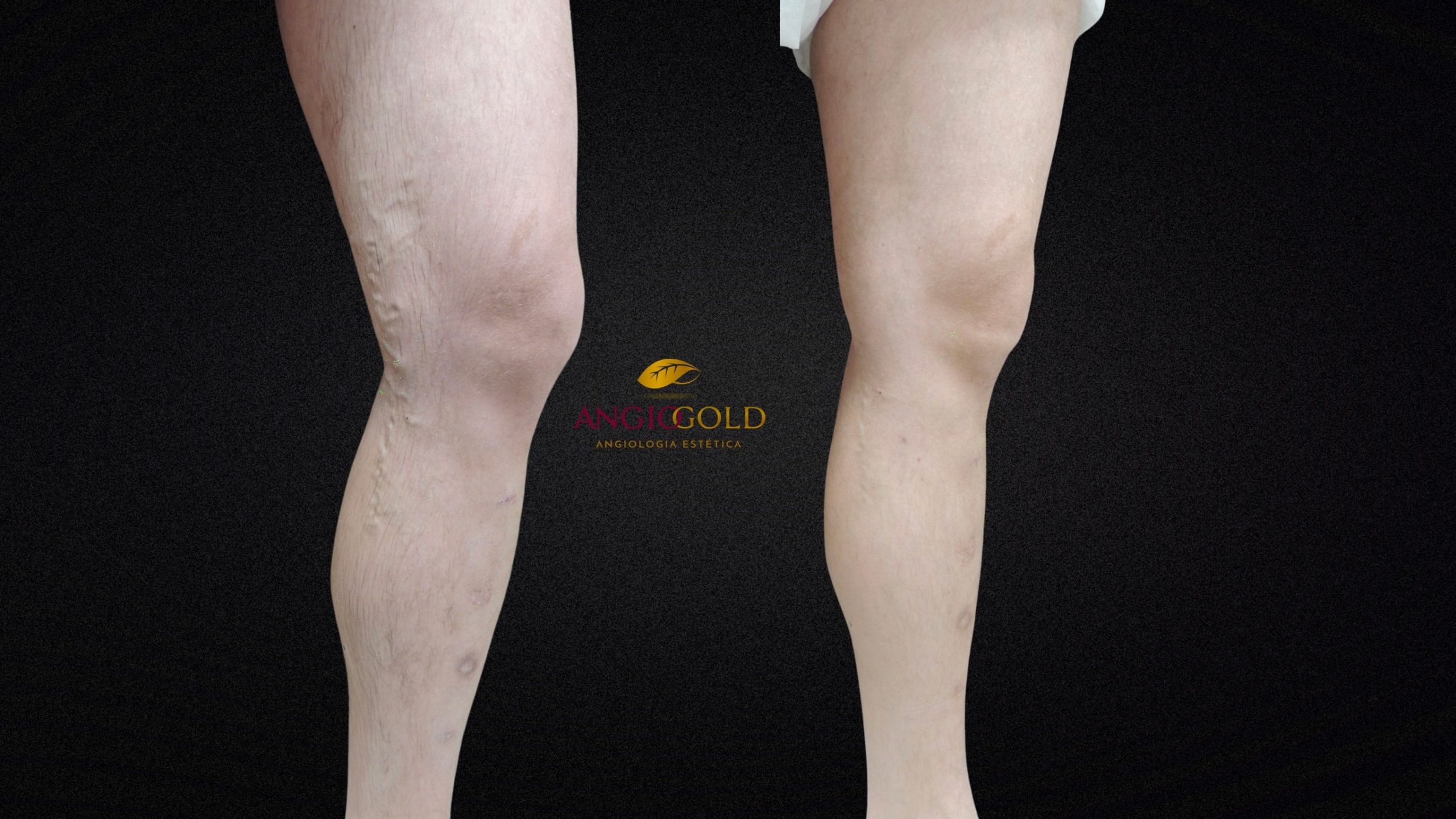 Antes e depois — varizes na região dos joelhos, AngioGold