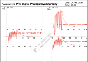 Gráfico do exame de fotopletismografia digital (D-PPG) mostrando curvas de refluxo venoso sem torniquete, com torniquete no joelho e com torniquete na perna
