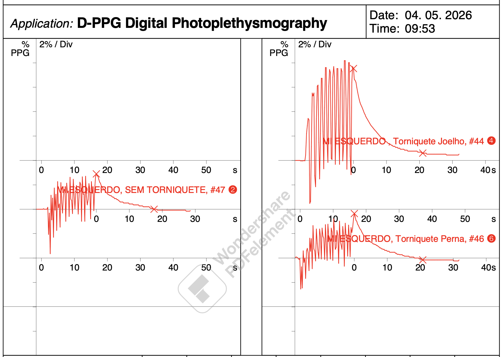 Curvas de fotopletismografia digital (D-PPG) mostrando avaliação do refluxo venoso sem torniquete, com torniquete no joelho e com torniquete na perna do membro inferior esquerdo