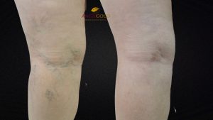 terapia compressiva para varizes: imagem ilustrativa — AngioGold