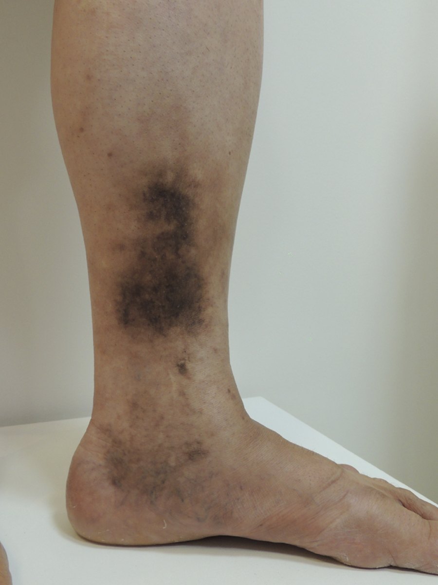 Perna com dermatite ocre: mancha escura acima do tornozelo, antes do tratamento