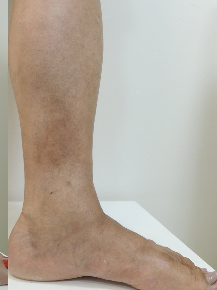 A mesma perna após o tratamento da dermatite ocre, com a mancha bem mais clara