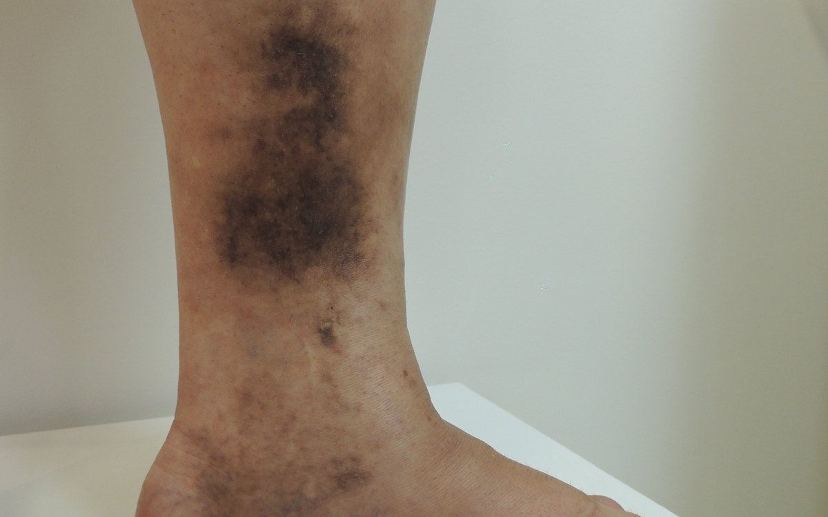Dermatite ocre: mancha escura na perna causada pela má circulação venosa