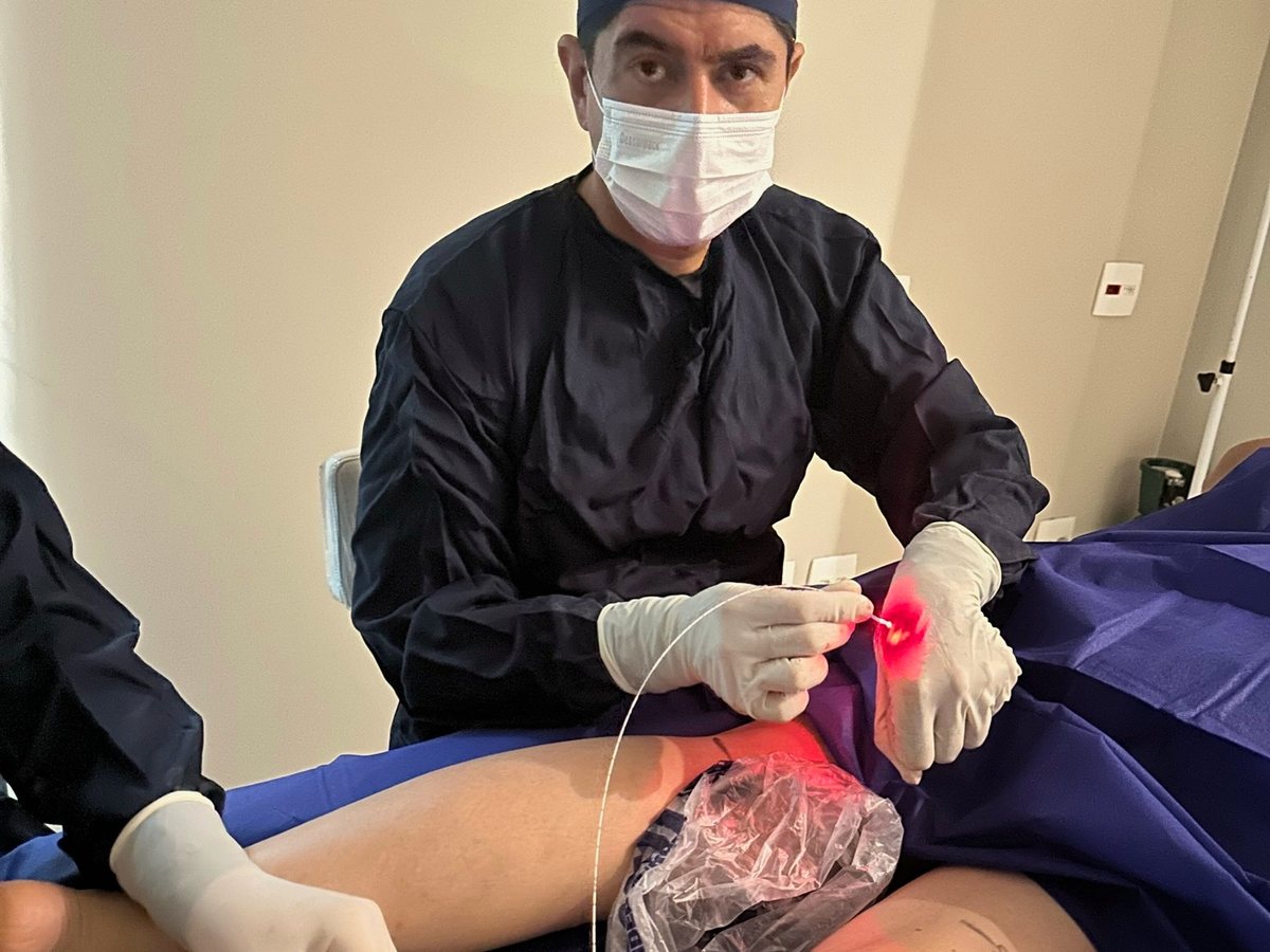 Fibra do laser com a ponta acesa em vermelho durante o endolaser